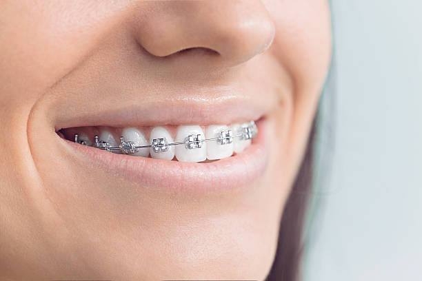 Dental Bonding in Theodore, AL
